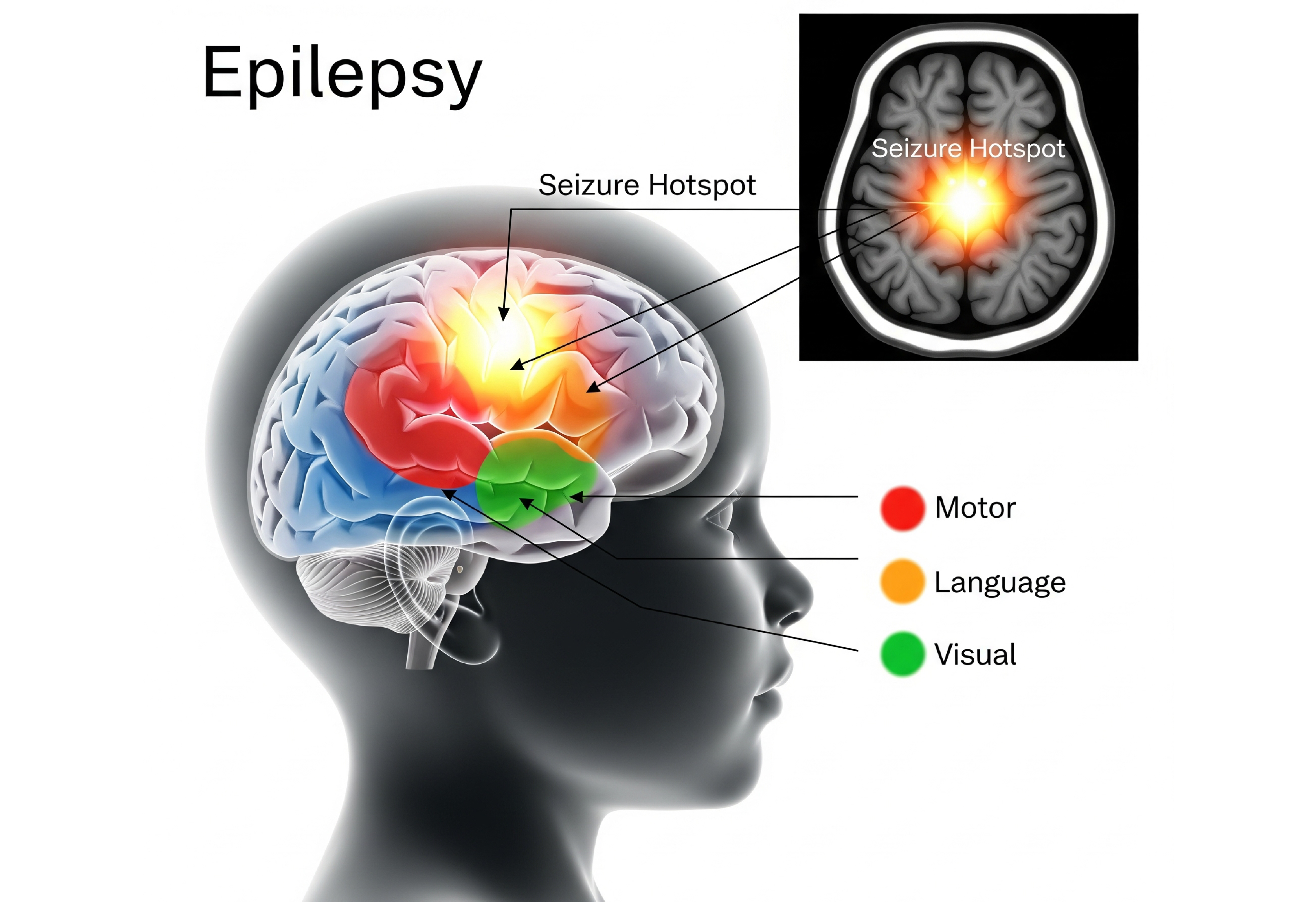 Epilepsy- Diagnosis and Treatment in Delhi